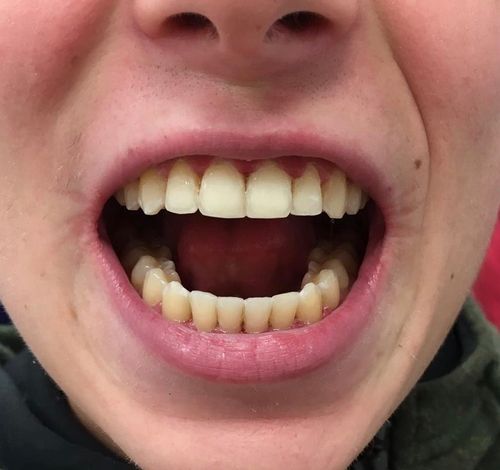 Alex - 6 month braces - after